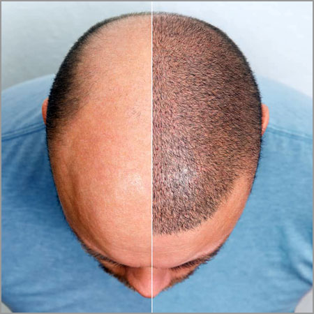 Unsere Leistungen: Beratung Haartransplantation