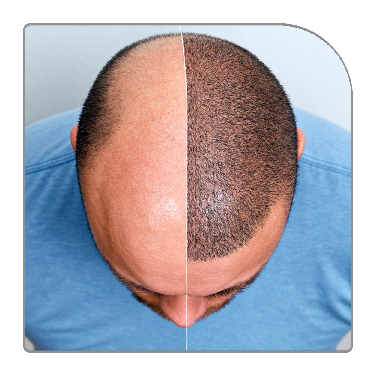 Unsere Leistungen: Beratung Haartransplantation